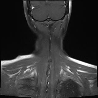File:Bilateral carotid body tumors and right jugular paraganglioma (Radiopaedia 20024-20060 None 20).jpg