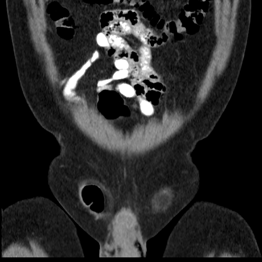 File:Bilateral direct inguinal herniae (Radiopaedia 17016-16719 A 4).jpg