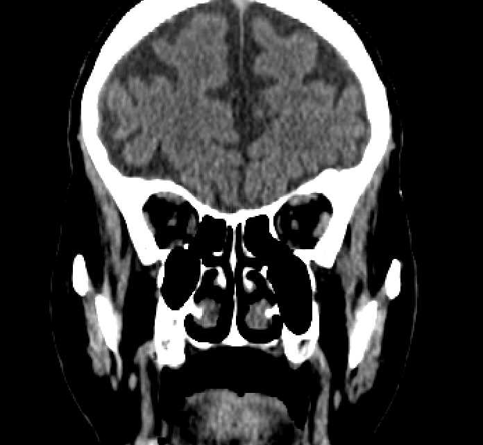 Bilateral ectopia lentis (Radiopaedia 89889-107013 Coronal non-contrast 79).jpg
