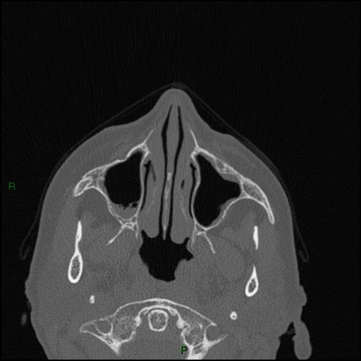 Bilateral frontal mucoceles (Radiopaedia 82352-96454 Axial bone window 205).jpg