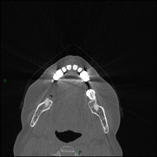 File:Bilateral frontal mucoceles (Radiopaedia 82352-96454 Axial bone window 282).jpg