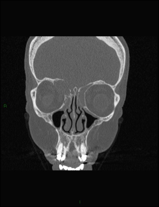 Bilateral frontal mucoceles (Radiopaedia 82352-96454 Coronal 114).jpg