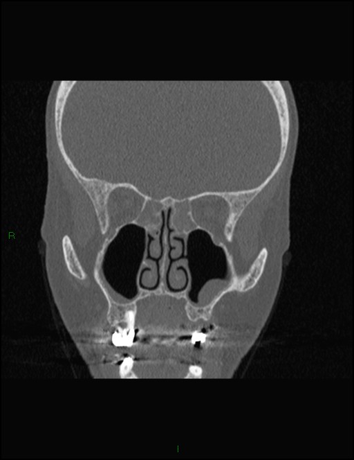 Bilateral frontal mucoceles (Radiopaedia 82352-96454 Coronal 156).jpg