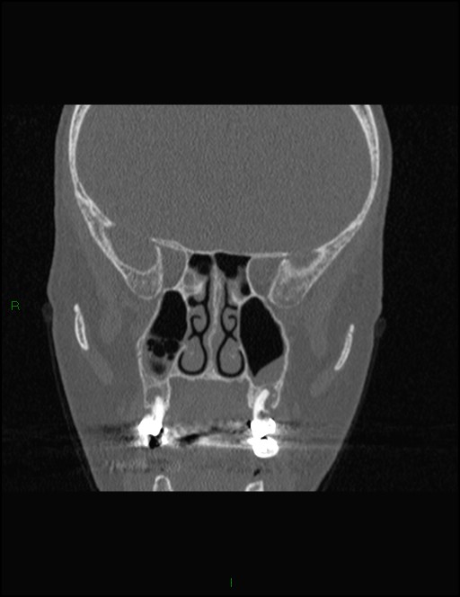Bilateral frontal mucoceles (Radiopaedia 82352-96454 Coronal 176).jpg