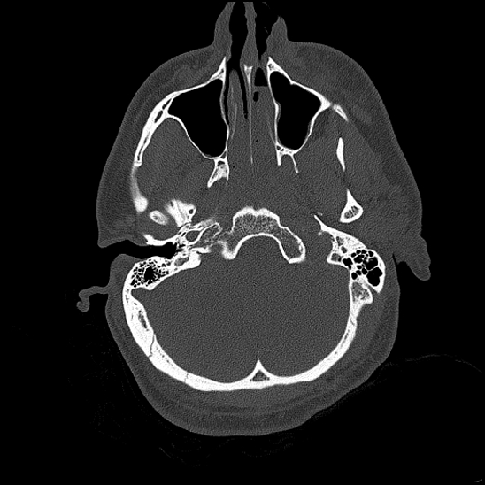 File:Bilateral occipital condyle fracture (type 2) (Radiopaedia 87675-104089 Axial bone thins 45).jpg