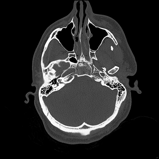 Bilateral occipital condyle fracture (type 2) (Radiopaedia 87675-104089 Axial bone thins 57).jpg