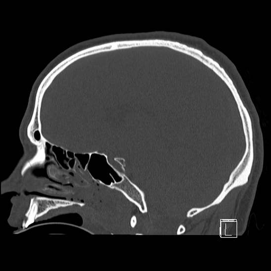 Bilateral occipital condyle fracture (type 2) (Radiopaedia 87675-104089 Sagittal bone window 48).jpg