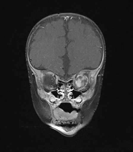 File:Bilateral optic pathway gliomas (Radiopaedia 40013-42514 D 2).jpg