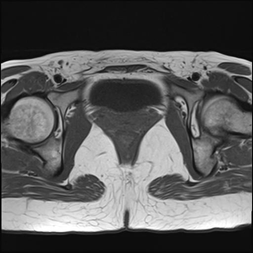 File:Bilateral ovarian endometriomas (Radiopaedia 87085-103347 Axial T1 18).jpg