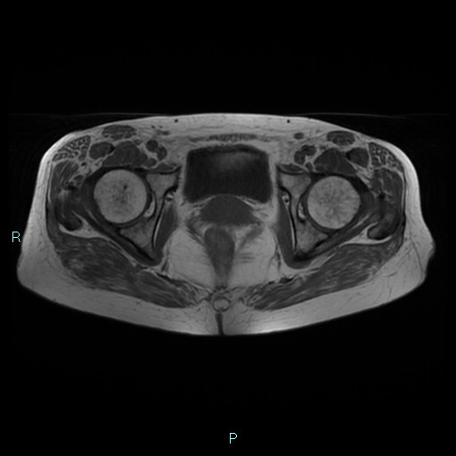 File:Bilateral ovarian fibroma (Radiopaedia 44568-48293 Axial T1 22).jpg
