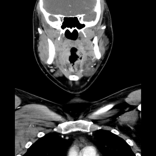 Bilateral peritonsillar abscess (Radiopaedia 85065-100610 Coronal 30).jpg