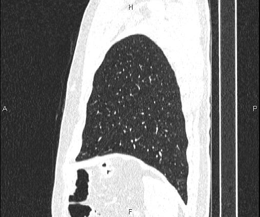 Bilateral pulmonary AVM (Radiopaedia 83134-97505 Sagittal lung window 95).jpg