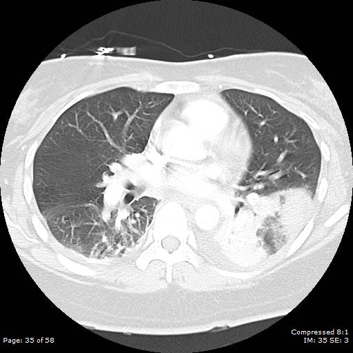 Bilateral pulmonary emboli with Hampton hump sign (Radiopaedia 54070-60246 Axial lung window 35).jpg