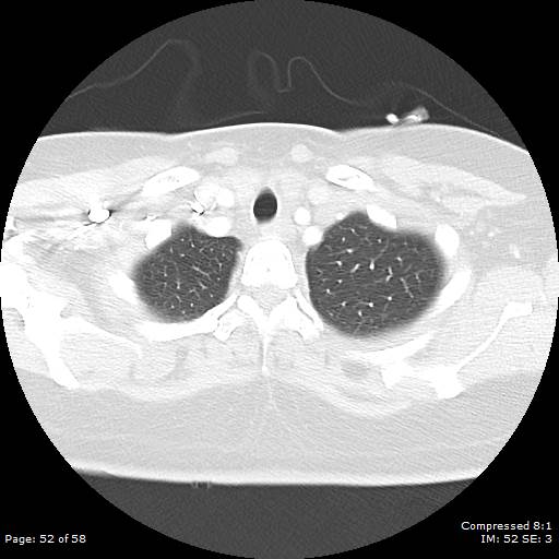 Bilateral pulmonary emboli with Hampton hump sign (Radiopaedia 54070-60246 Axial lung window 52).jpg