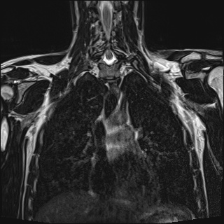 Bilateral spinoglenoid notch ganglion cysts (Radiopaedia 29577-30082 Coronal T2 63).jpg