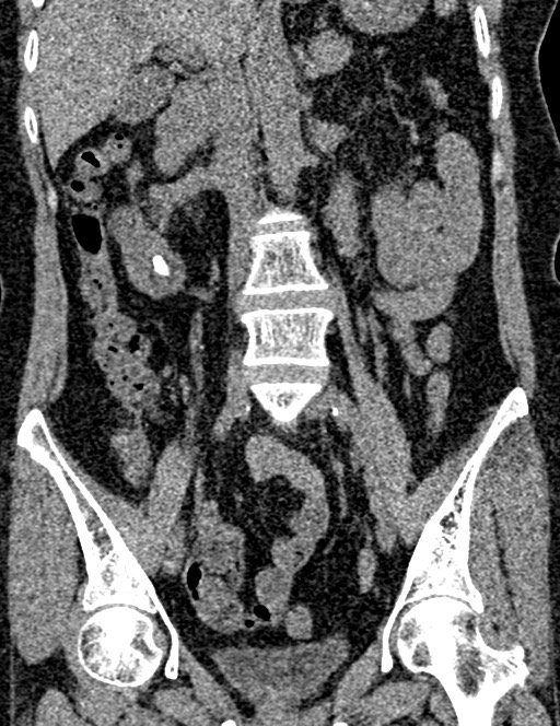 Bilateral staghorn calculi (Radiopaedia 59475-66842 Coronal non-contrast 58).jpg