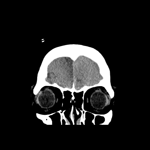 Bilateral subacute subdural hematoma (Radiopaedia 69240-79018 Coronal non-contrast 7).jpg