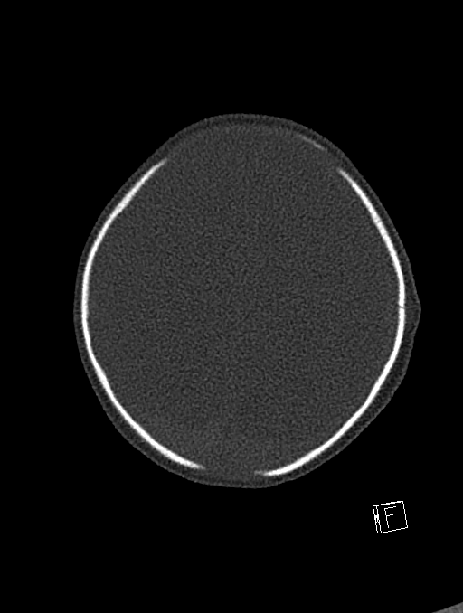 Bilateral subdural hemorrhage and parietal skull fracture (Radiopaedia 26058-26192 Axial bone window 25).png