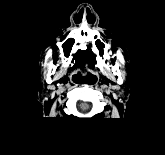 Bilateral subdural hygroma (Radiopaedia 73637-84421 Axial 53).jpg