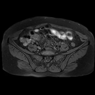 Bilateral tubo-ovarian abscesses (Radiopaedia 58635-65829 Axial T1 fat sat 4).jpg