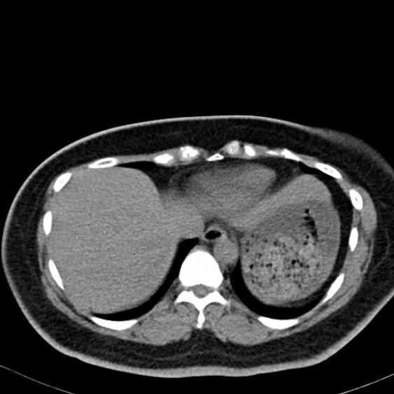 File:Bilateral ureteric stents (Radiopaedia 48795-53825 Axial non-contrast 2).jpg