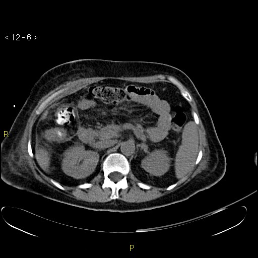 File:Biloma with drainage into the colon (Radiopaedia 20032-20068 B 15).jpg