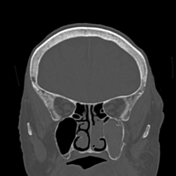 Biparietal osteodystrophy (Radiopaedia 46109-50463 Coronal bone window 34).jpg