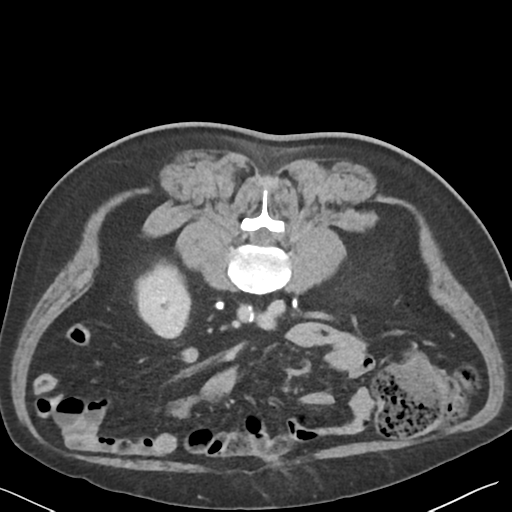 File:Bladder papillary urothelial carcinoma (Radiopaedia 48119-52951 Axial C+ delayed 27).png