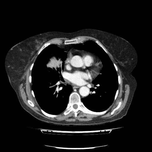 File:Bladder tumor detected on trauma CT (Radiopaedia 51809-57609 B 4).jpg