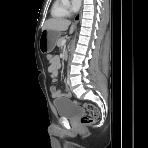 File:Blunt abdominal trauma with solid organ and musculoskelatal injury with active extravasation (Radiopaedia 68364-77895 C 75).jpg