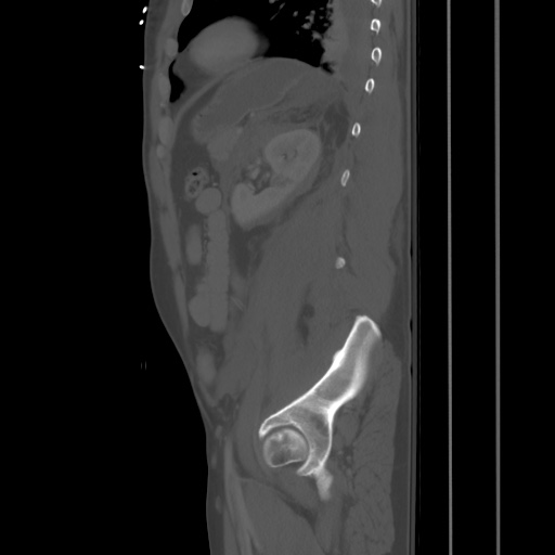 Blunt abdominal trauma with solid organ and musculoskelatal injury with active extravasation (Radiopaedia 68364-77895 Sagittal bone window 78).jpg