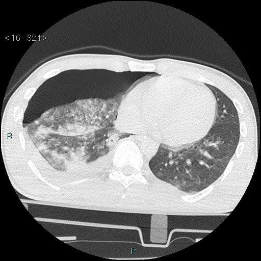 Blunt chest trauma (Swiss cheese sign) (Radiopaedia 38519-40618 Axial lung window 54).jpg