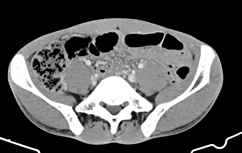 Blunt injury to the small bowel (Radiopaedia 74953-85987 A 135).jpg