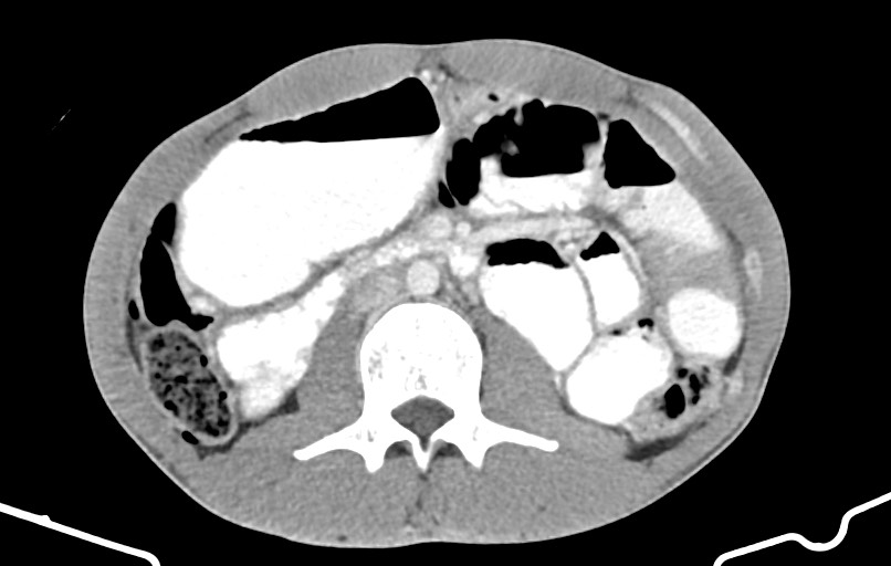 Blunt injury to the small bowel (Radiopaedia 74953-85987 A 79).jpg
