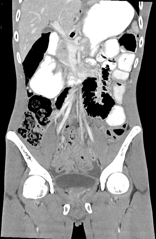 Blunt injury to the small bowel (Radiopaedia 74953-85987 B 43).jpg