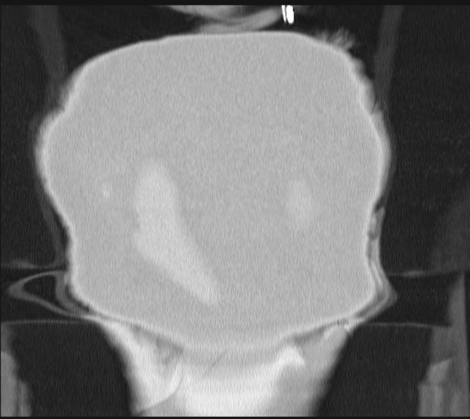 Boerhaave syndrome (Radiopaedia 45644-49799 Coronal lung window 72).jpg