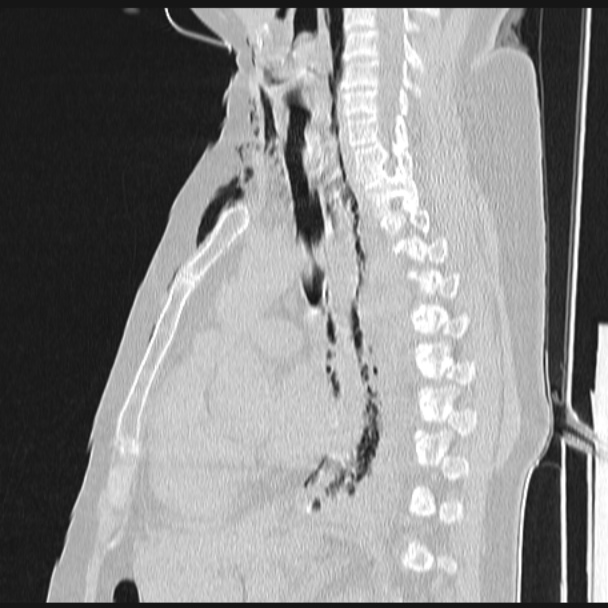 Boerhaave syndrome (Radiopaedia 45644-49799 Sagittal lung window 38).jpg