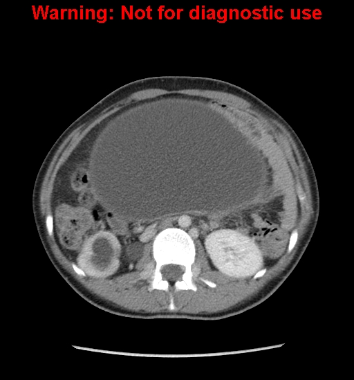 Borderline mucinous cystadenoma of ovary (Radiopaedia 25586-25767 A 14).jpg
