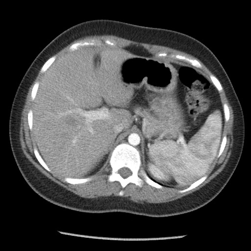 File:Borderline mucinous tumor (ovary) (Radiopaedia 78228-90808 A 44).jpg