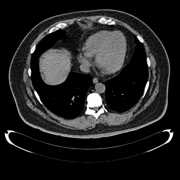 Bosniak renal cyst - type IV (Radiopaedia 24244-24518 Axial non-contrast 14).jpg