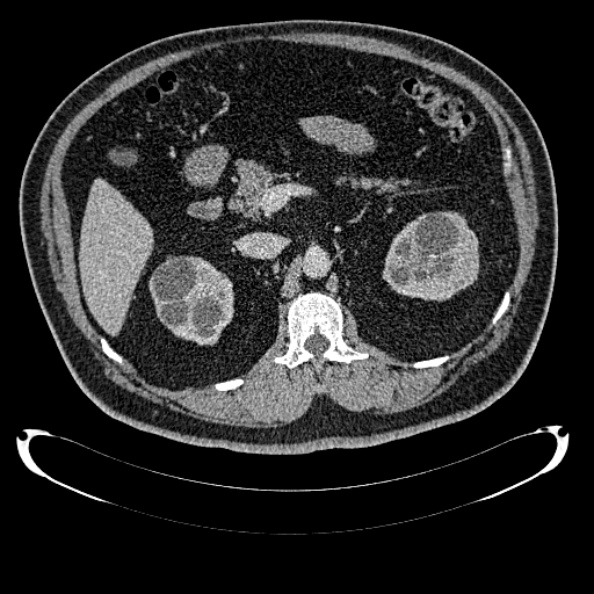Bosniak renal cyst - type IV (Radiopaedia 24244-24518 C 118).jpg