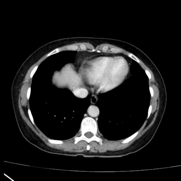 Bosniak renal cyst - type I (Radiopaedia 27479-27675 C 4).jpg