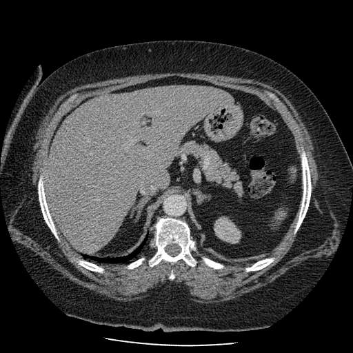 Bovine aortic arch - right internal mammary vein drains into the superior vena cava (Radiopaedia 63296-71875 A 175).jpg