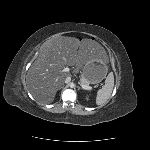 Bowel and splenic infarcts in acute lymphocytic leukemia (Radiopaedia 61055-68915 A 46).jpg