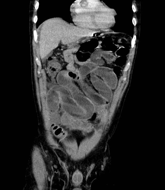 Bowel obstruction from colon carcinoma (Radiopaedia 22995-23028 C 17).jpg