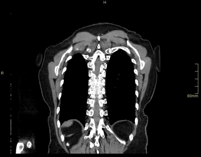 Brachial artery foreign body (Radiopaedia 54583-60820 Coronal non-contrast 51).jpg