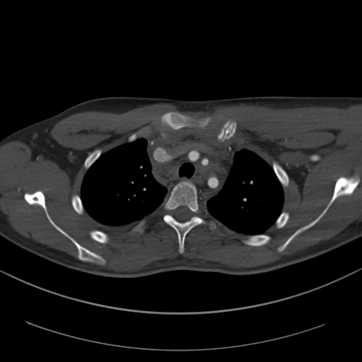 Brachiocephalic trunk pseudoaneurysm (Radiopaedia 70978-81191 Axial bone window 59).jpg
