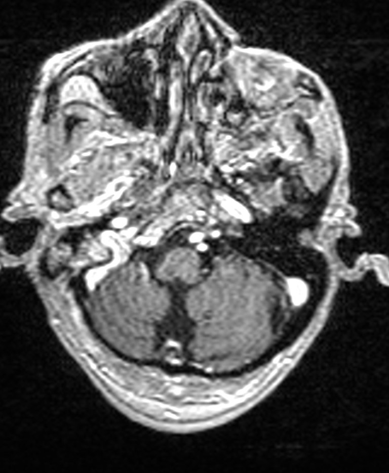 Brain abscess with dual rim sign (Radiopaedia 87566-103938 Axial T1 C+ 34).jpg