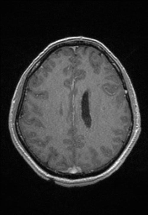 Brain abscess with ventriculitis (Radiopaedia 85703-101495 Axial T1 C+ 120).jpg