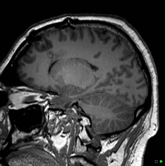 Brain death on MRI and CT angiography (Radiopaedia 42560-45689 Sagittal T1 42).jpg